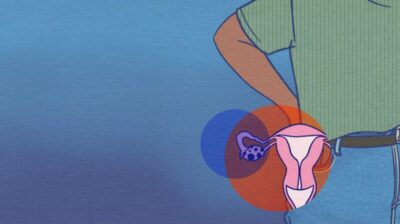 What are polycystic ovaries (PCOS)?