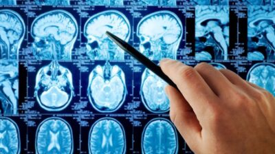 All you need to know about epilepsy