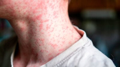 Signs and symptoms of measles