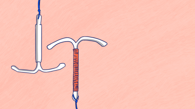 The coil: What is the difference between an IUD and an IUS?